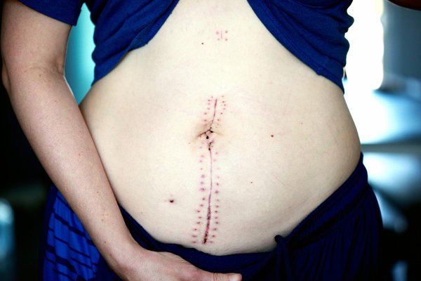Abdominoplastie à Paris : tout ce que vous devez savoir